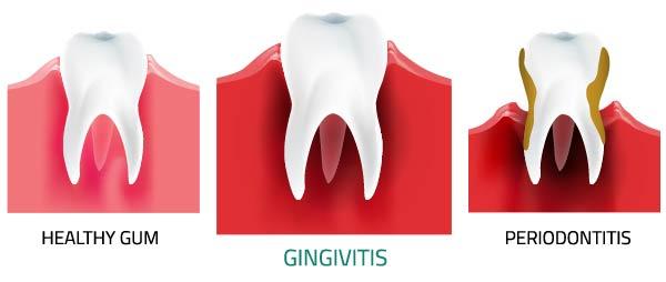 Illustration of Gingivitis and Periodontitis