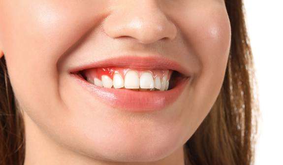 Woman with inflammation of the gums