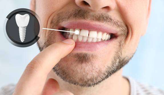 implants inside Man showing his tooth with implant