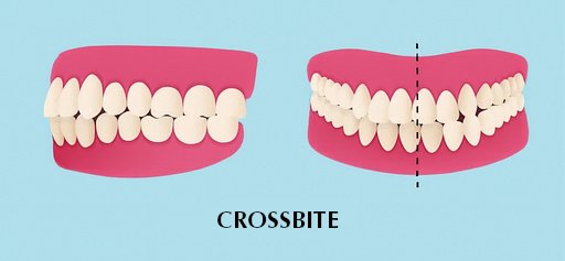 Illustration of a dental crossbite, showing two sets of teeth. The left image displays a side view, while the right shows a front view with misalignment indicated.