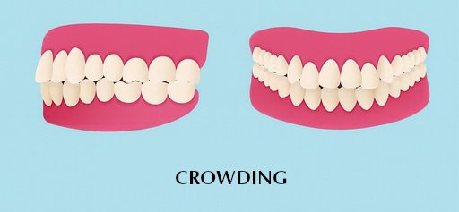 Illustration showing dental crowding due to malocclusion. Two views of crowded teeth are depicted against a blue background, highlighting overlapping in the dental arches.