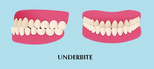 Illustration of an underbite, showing a side view and a front view of teeth misalignment where the lower teeth protrude beyond the upper teeth, against a blue background.